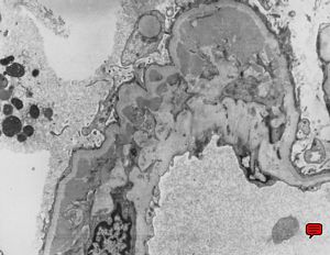  M,44y. | IgA nephropathy